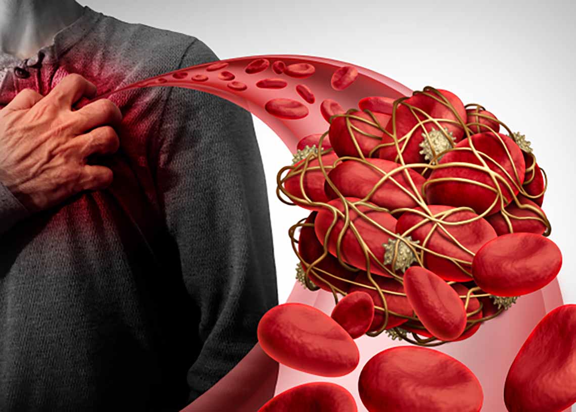 通血路酵素推薦！比納豆激酶更有效的血栓溶解劑