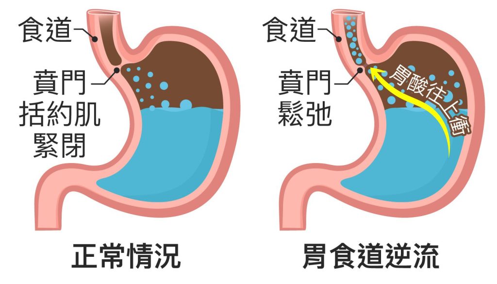 胃食道逆流自己會好嗎?專家這樣答 | 大保健家